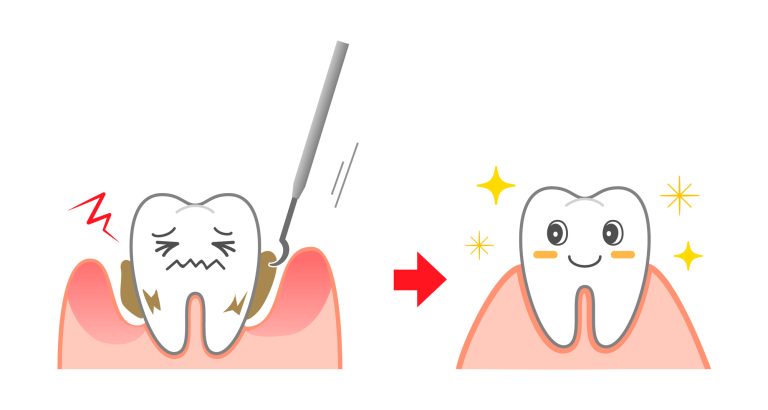 歯のクリーニング